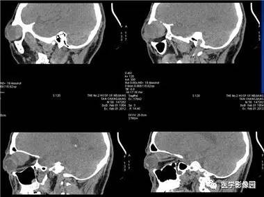 【病例】眼眶腺样囊性癌1例CT影像表现 【病例】眼眶腺样囊性癌1例CT影像表现