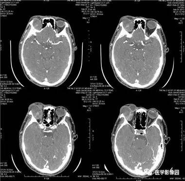 【病例】眼眶腺样囊性癌1例CT影像表现 【病例】眼眶腺样囊性癌1例CT影像表现