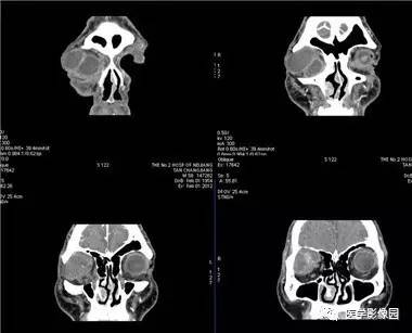 【病例】眼眶腺样囊性癌1例CT影像表现 【病例】眼眶腺样囊性癌1例CT影像表现