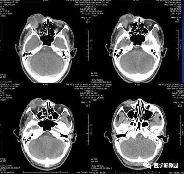 【病例】眼眶腺样囊性癌1例CT影像表现 【病例】眼眶腺样囊性癌1例CT影像表现