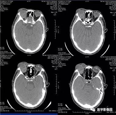 【病例】眼眶腺样囊性癌1例CT影像表现 【病例】眼眶腺样囊性癌1例CT影像表现