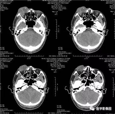 【病例】眼眶腺样囊性癌1例CT影像表现 【病例】眼眶腺样囊性癌1例CT影像表现