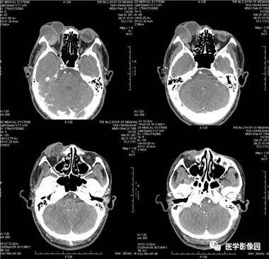 【病例】眼眶腺样囊性癌1例CT影像表现 【病例】眼眶腺样囊性癌1例CT影像表现