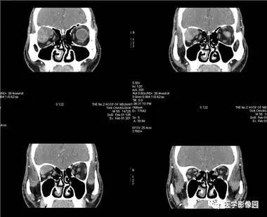 【病例】眼眶腺样囊性癌1例CT影像表现 【病例】眼眶腺样囊性癌1例CT影像表现