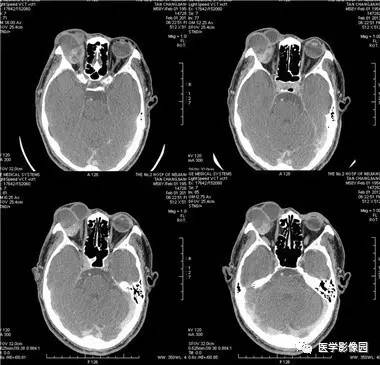 【病例】眼眶腺样囊性癌1例CT影像表现 【病例】眼眶腺样囊性癌1例CT影像表现