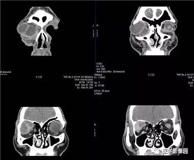 【病例】眼眶腺样囊性癌1例CT影像表现 【病例】眼眶腺样囊性癌1例CT影像表现