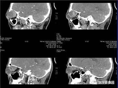 【病例】眼眶腺样囊性癌1例CT影像表现 【病例】眼眶腺样囊性癌1例CT影像表现