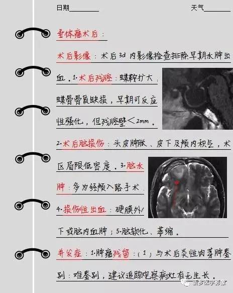 垂体瘤术后我们应该注意的12点内容
