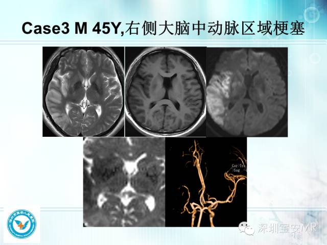 【PPT】颅内动脉供血区域解剖及临床影像