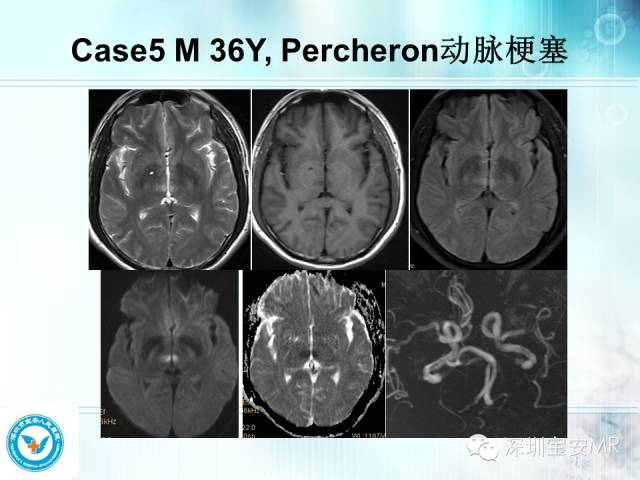 【PPT】颅内动脉供血区域解剖及临床影像