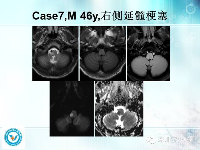 【PPT】颅内动脉供血区域解剖及临床影像