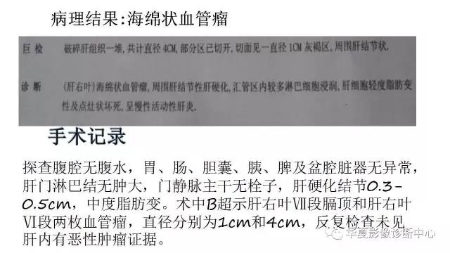 【病例】肝硬化伴海绵状血管瘤1例 【病例】肝硬化伴海绵状血管瘤1例