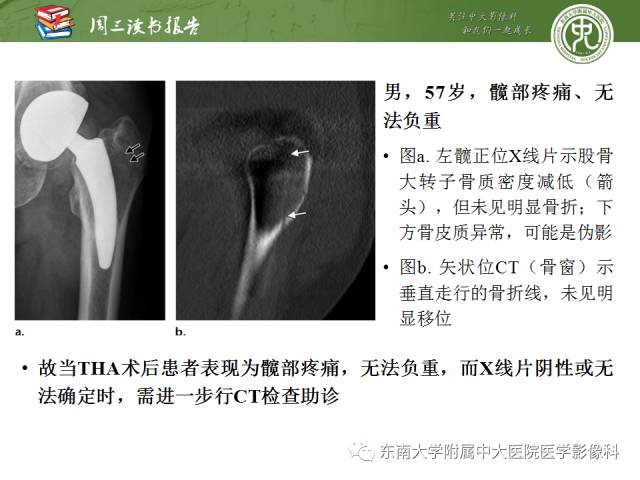 【PPT】股骨假体周围骨折：骨科医生想知道什么