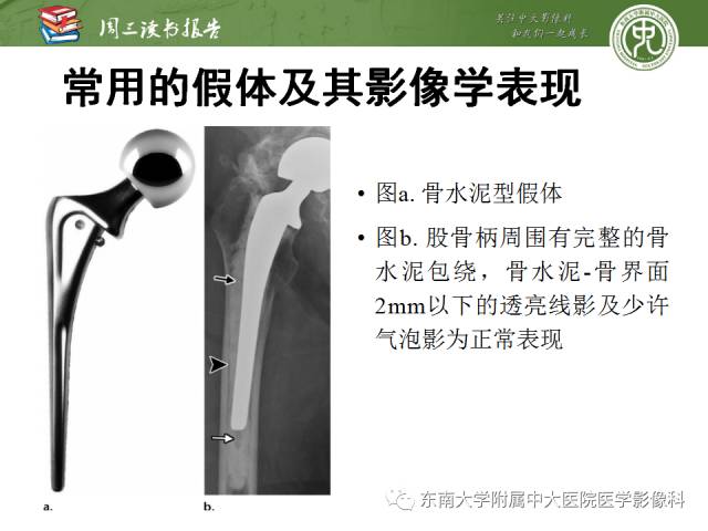 【PPT】股骨假体周围骨折：骨科医生想知道什么