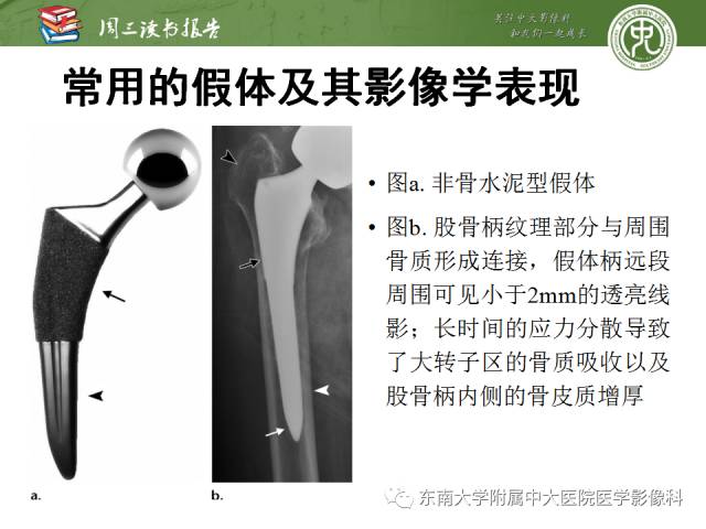 【PPT】股骨假体周围骨折：骨科医生想知道什么