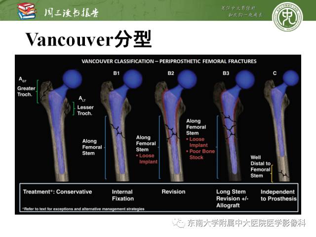 【PPT】股骨假体周围骨折：骨科医生想知道什么