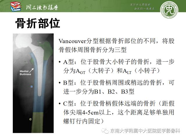 【PPT】股骨假体周围骨折：骨科医生想知道什么