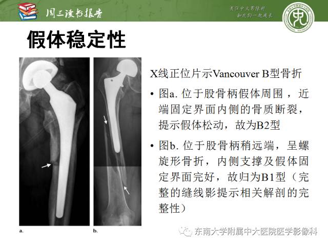 【PPT】股骨假体周围骨折：骨科医生想知道什么