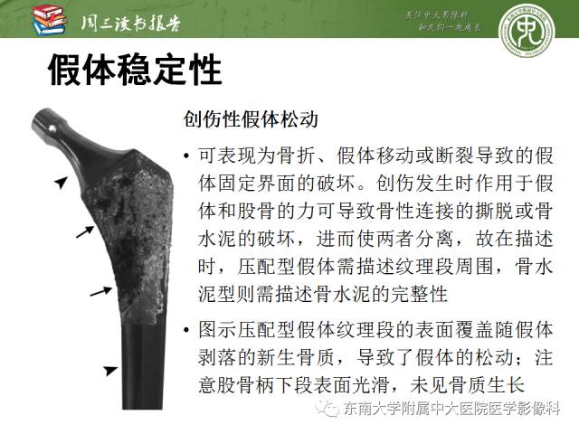 【PPT】股骨假体周围骨折：骨科医生想知道什么