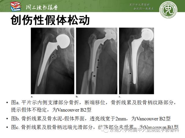 【PPT】股骨假体周围骨折：骨科医生想知道什么