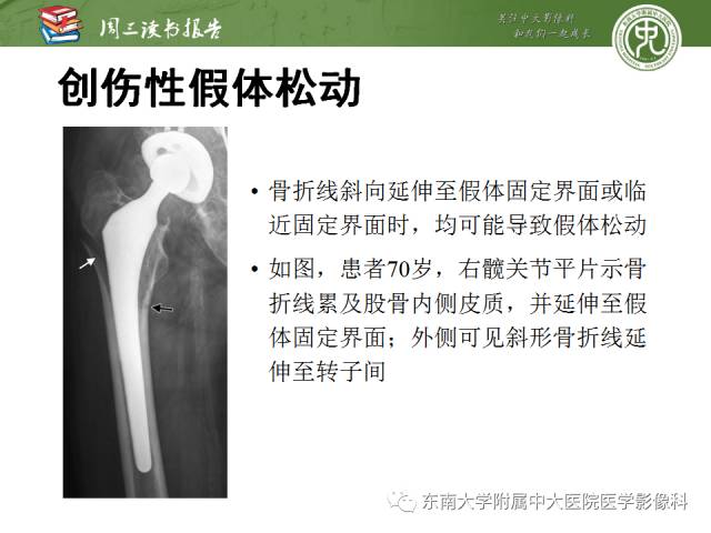 【PPT】股骨假体周围骨折：骨科医生想知道什么