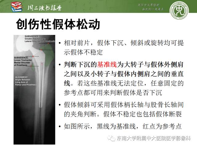 【PPT】股骨假体周围骨折：骨科医生想知道什么