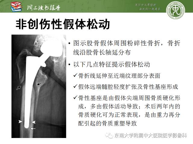【PPT】股骨假体周围骨折：骨科医生想知道什么