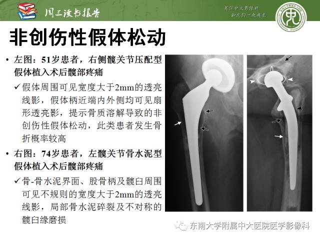 【PPT】股骨假体周围骨折：骨科医生想知道什么
