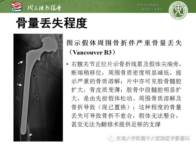 【PPT】股骨假体周围骨折：骨科医生想知道什么