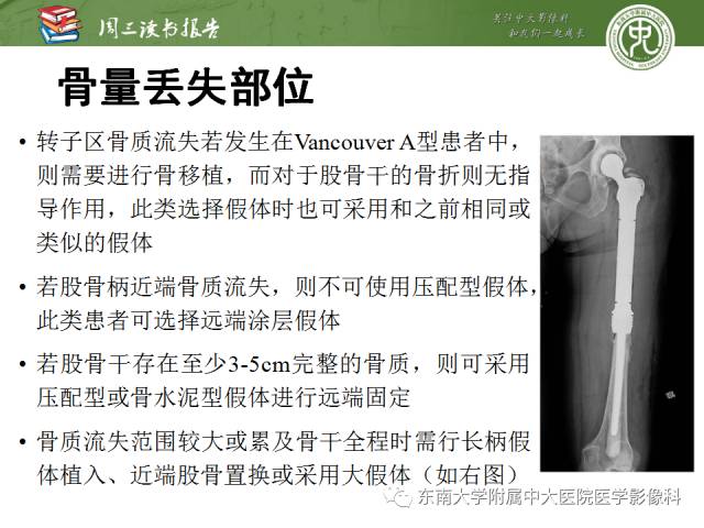 【PPT】股骨假体周围骨折：骨科医生想知道什么