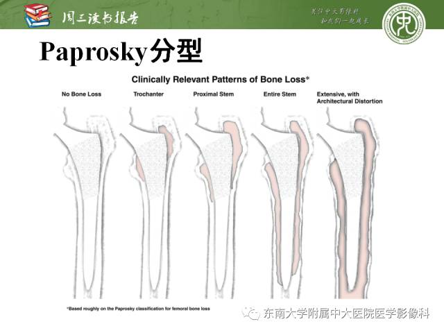 【PPT】股骨假体周围骨折：骨科医生想知道什么