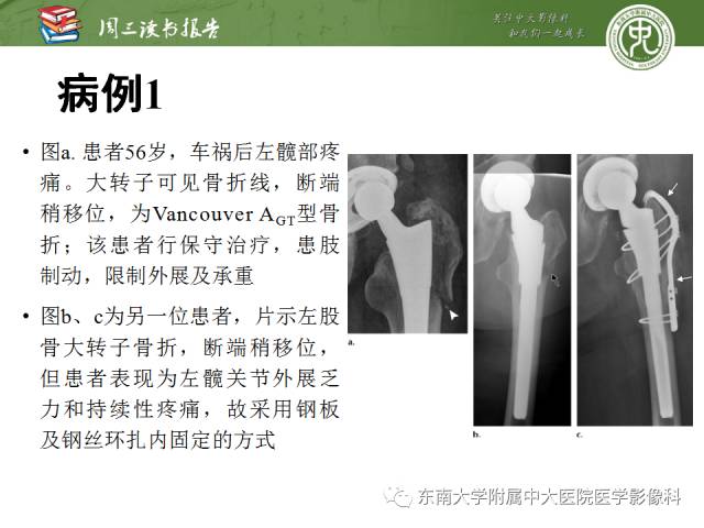 【PPT】股骨假体周围骨折：骨科医生想知道什么