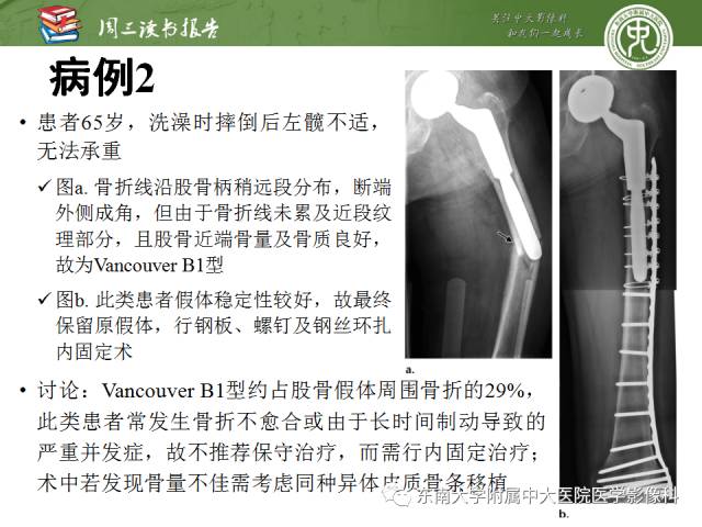 【PPT】股骨假体周围骨折：骨科医生想知道什么