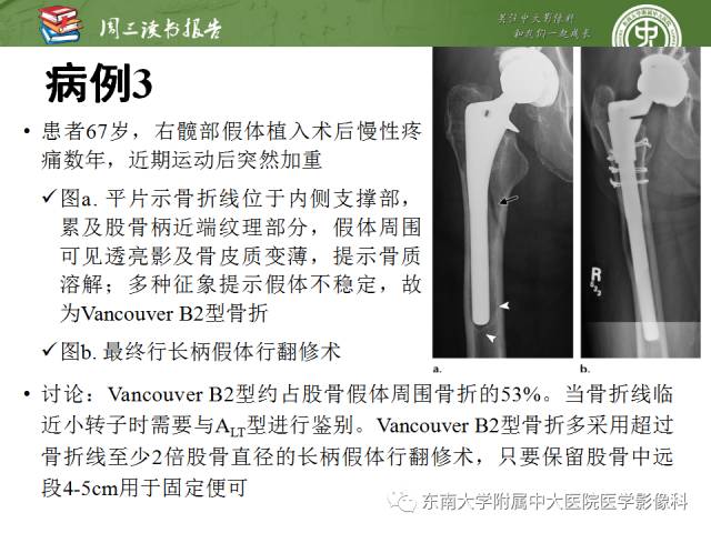 【PPT】股骨假体周围骨折：骨科医生想知道什么