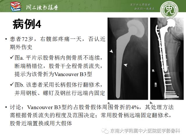 【PPT】股骨假体周围骨折：骨科医生想知道什么