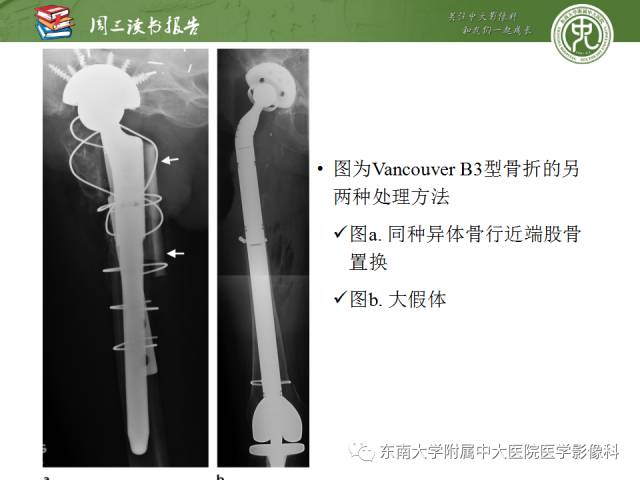 【PPT】股骨假体周围骨折：骨科医生想知道什么