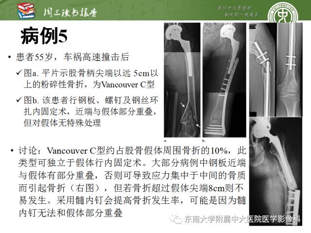 【PPT】股骨假体周围骨折：骨科医生想知道什么