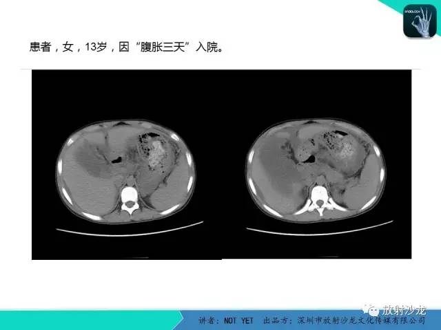 【病例】结核性腹膜炎1例CT影像表现