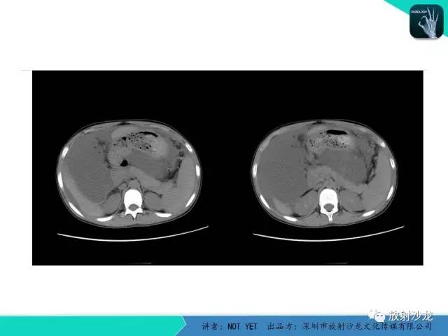 【病例】结核性腹膜炎1例CT影像表现 【病例】结核性腹膜炎1例CT影像表现