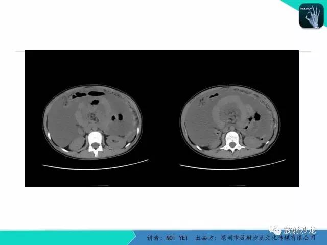 【病例】结核性腹膜炎1例CT影像表现 【病例】结核性腹膜炎1例CT影像表现