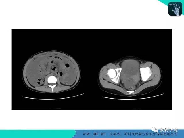 【病例】结核性腹膜炎1例CT影像表现 【病例】结核性腹膜炎1例CT影像表现