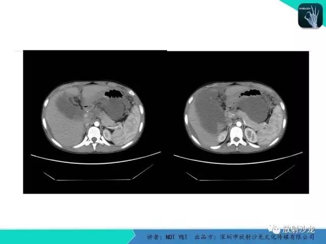 【病例】结核性腹膜炎1例CT影像表现 【病例】结核性腹膜炎1例CT影像表现