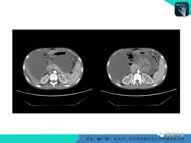 【病例】结核性腹膜炎1例CT影像表现 【病例】结核性腹膜炎1例CT影像表现