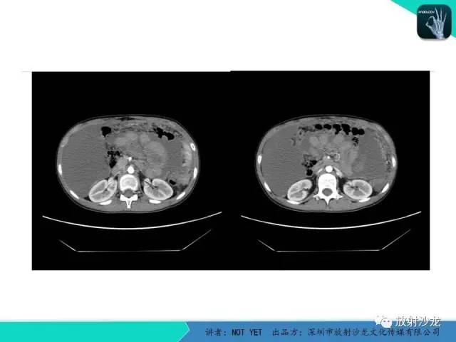 【病例】结核性腹膜炎1例CT影像表现 【病例】结核性腹膜炎1例CT影像表现