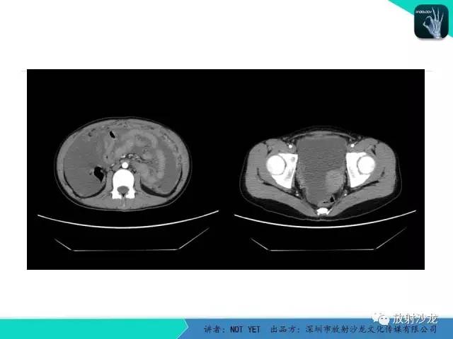 【病例】结核性腹膜炎1例CT影像表现 【病例】结核性腹膜炎1例CT影像表现