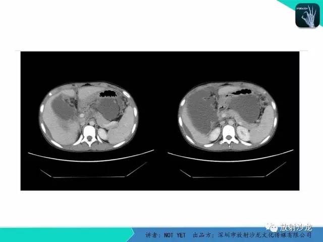 【病例】结核性腹膜炎1例CT影像表现 【病例】结核性腹膜炎1例CT影像表现