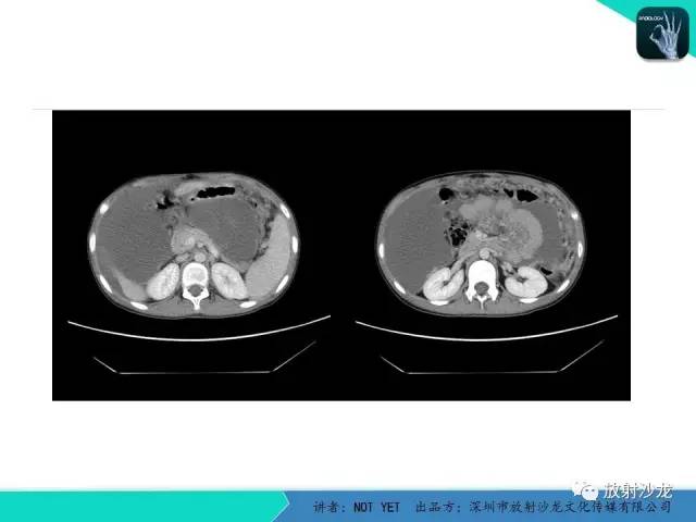 【病例】结核性腹膜炎1例CT影像表现 【病例】结核性腹膜炎1例CT影像表现