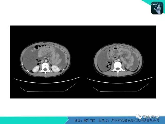 【病例】结核性腹膜炎1例CT影像表现 【病例】结核性腹膜炎1例CT影像表现