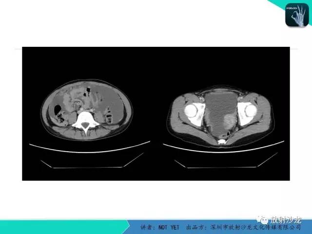 【病例】结核性腹膜炎1例CT影像表现 【病例】结核性腹膜炎1例CT影像表现