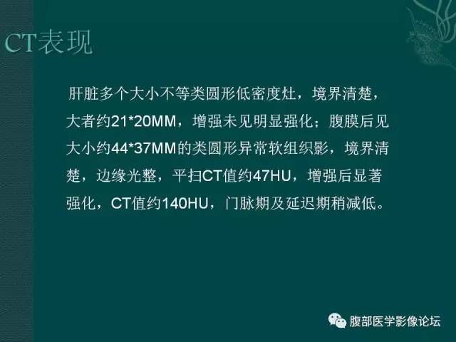 【病例】腹膜后副神经节瘤1例CT影像表现 【病例】腹膜后副神经节瘤1例CT影像表现